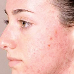 Acne-prone-skin copy